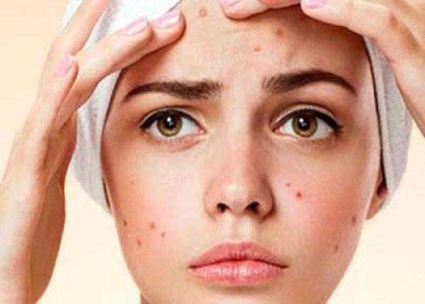 ساده ترین روش از بین بردن جای جوش روی صورت